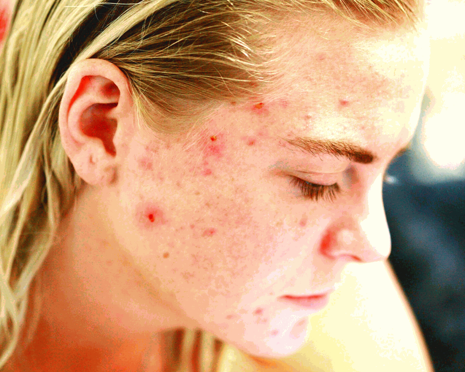 Sea Moss and Acne