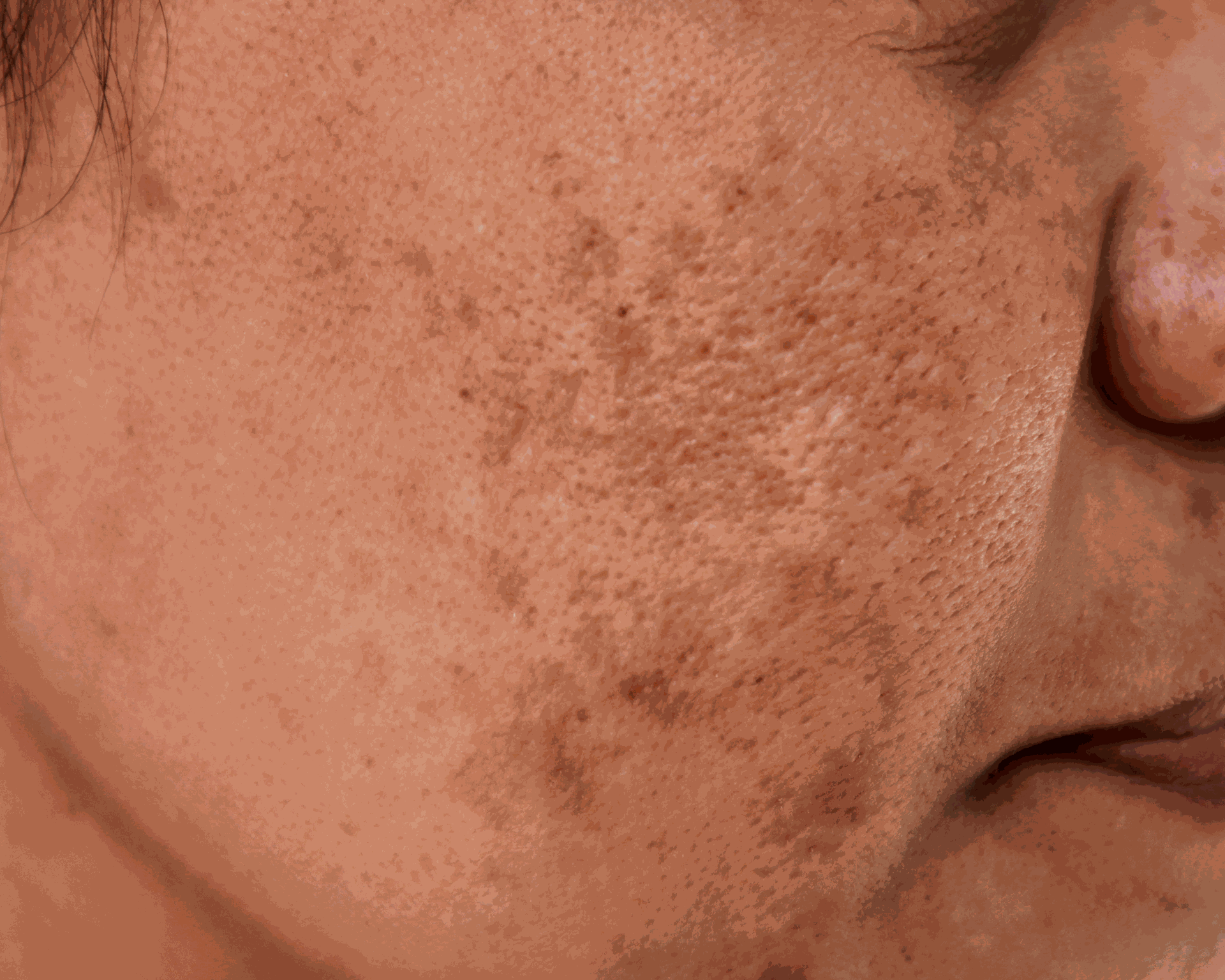 Sea Moss and Acne